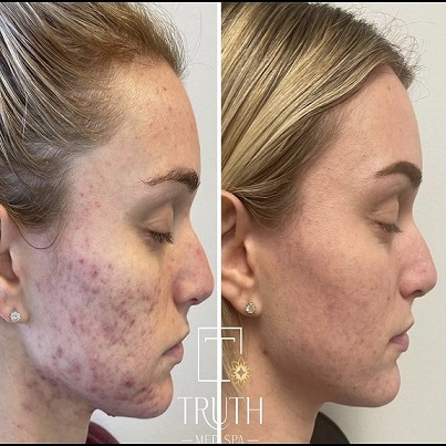 Acne Scars on Girl's face | Before and After Photo | TRUTH Med Spa | Lakewood, CA