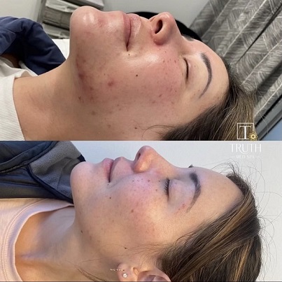 Acne Scar Treatment | Before and After Photo | TRUTH Med Spa | Lakewood, CA