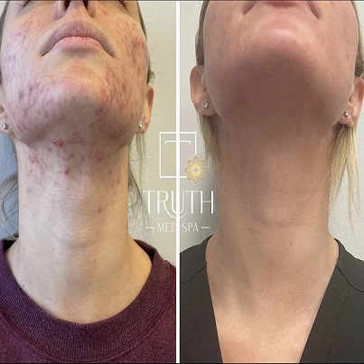 Skin Redness Treatment | Before and After Photo | TRUTH Med Spa | Lakewood, CA