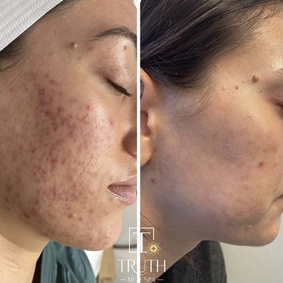 Skin Before and after image | Truth Medspa | Lakewood CO