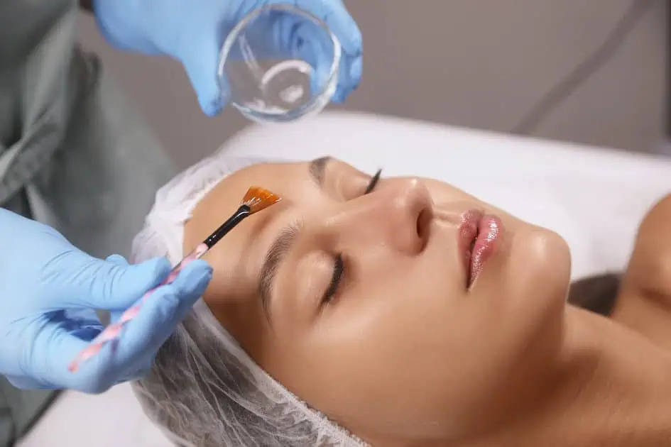 Chemical Peels After Botox