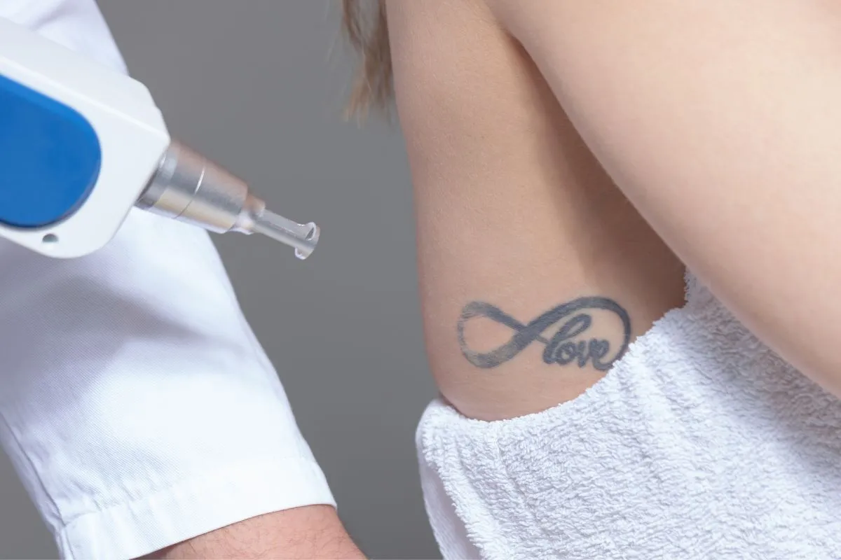 Professional tattoo removal process at a clinic in Lakewood, CO