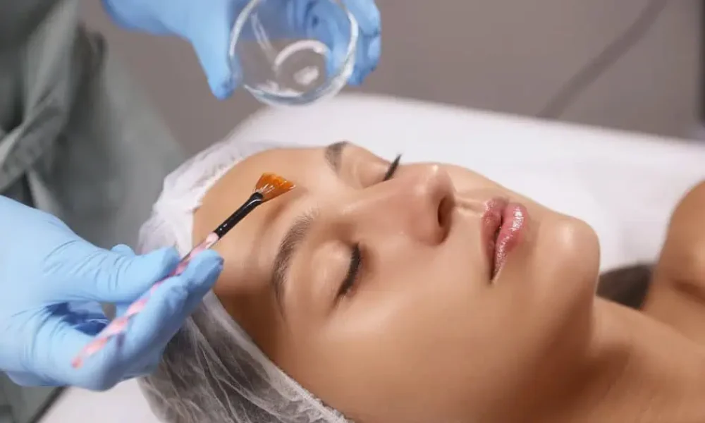 Chemical Peels After Botox