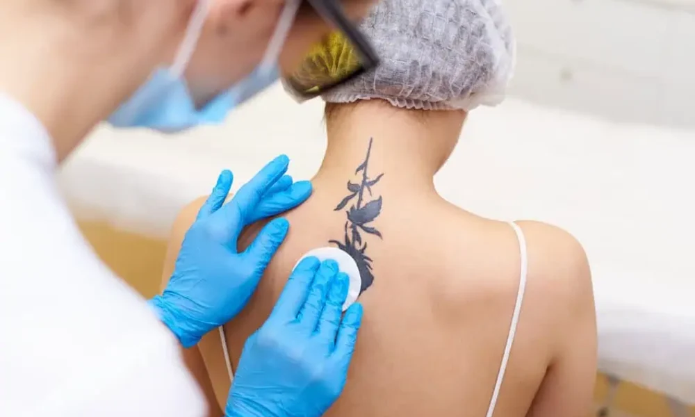 Tattoo Removal by Truth Med Spa in Lakewood, CO